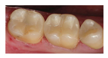Cerec_After-01