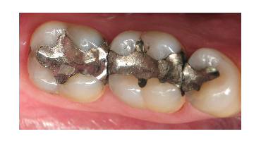 Cerec_Before-01