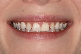 jg_before_frnt_lip