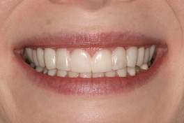 jg_sos_frnt_lip1