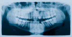 xray