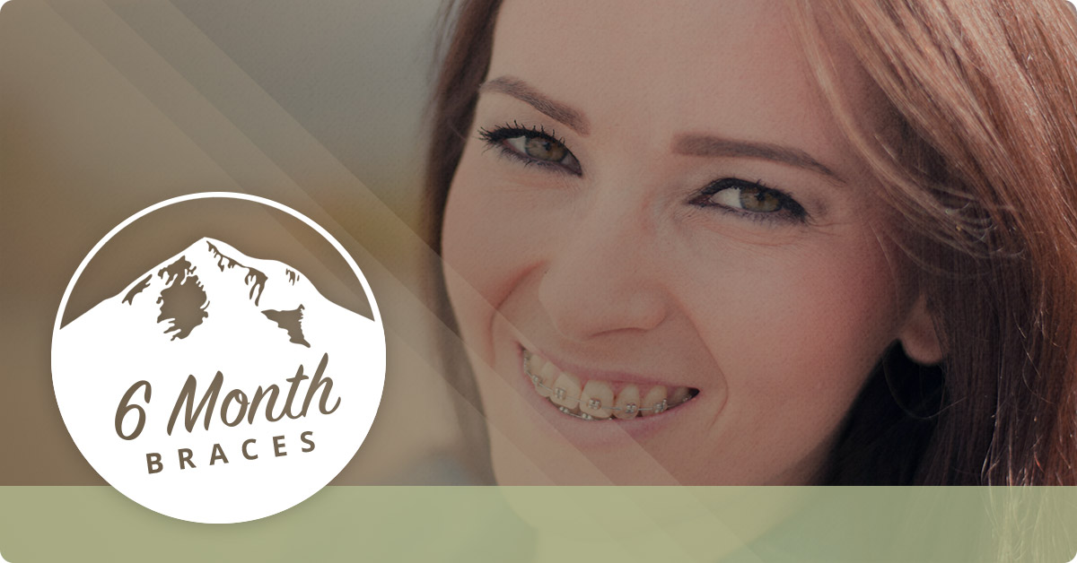 6-Month-Braces-5c2cf83e373b8