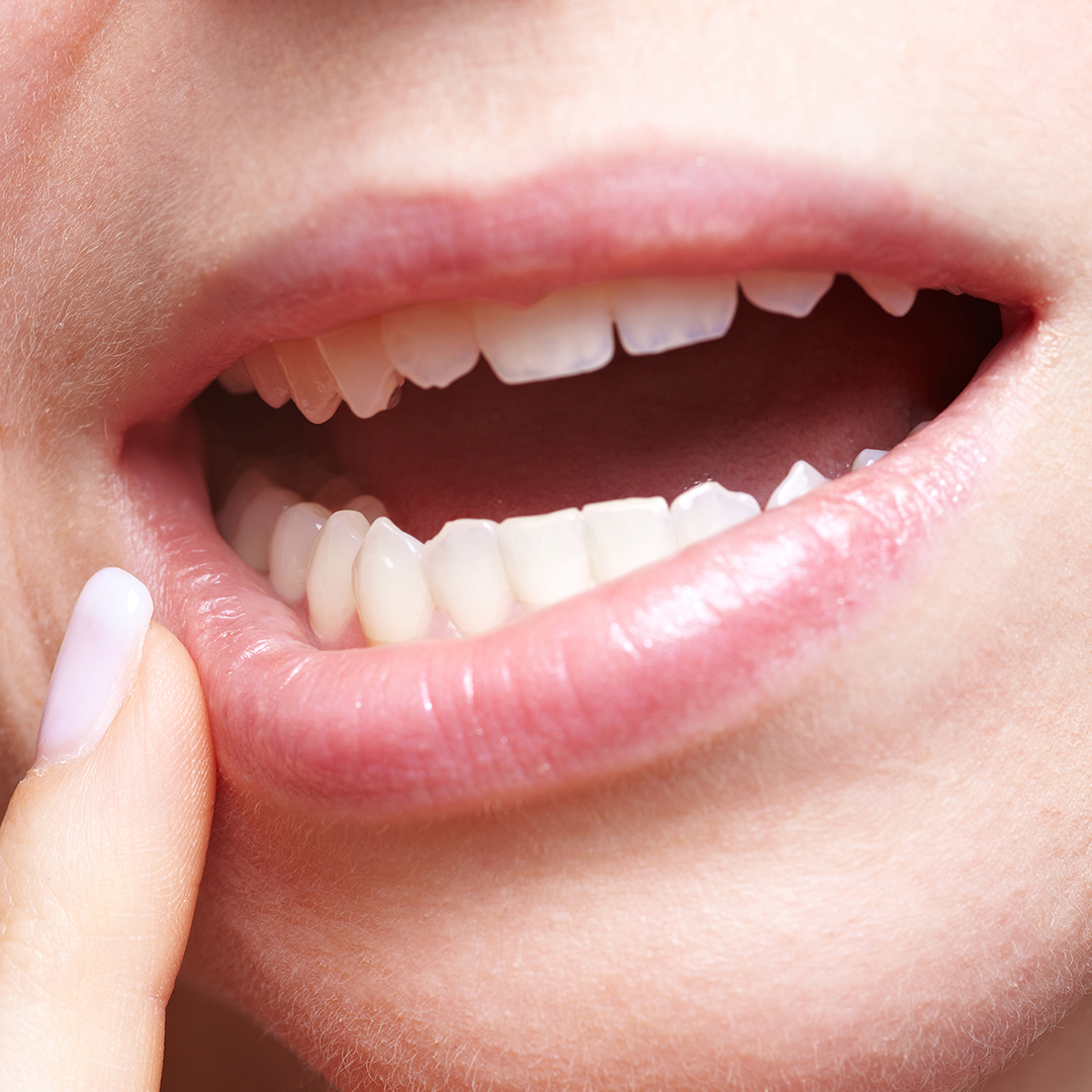Image of a person looking at their gums