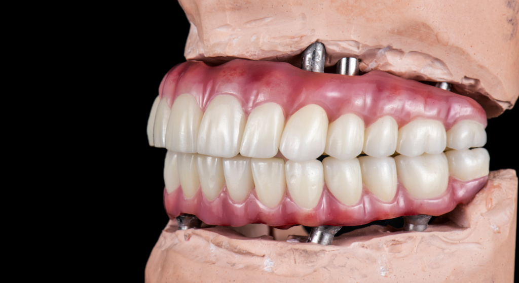 dental implants.