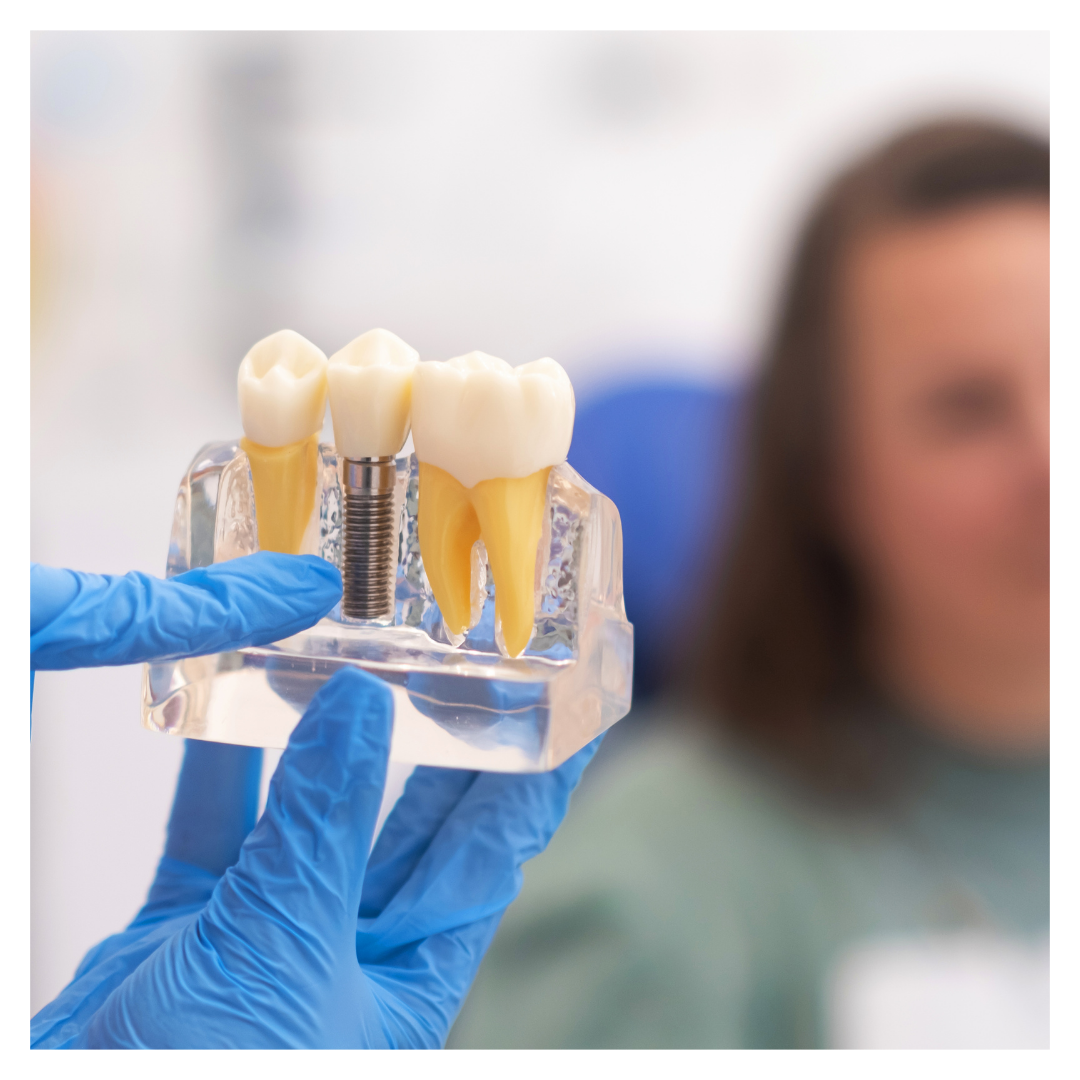 Dental implants.