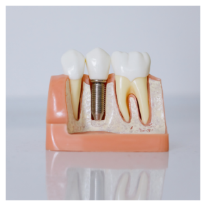 dental implants.