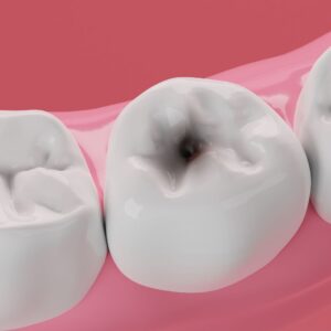 tooth with cavity graphic
