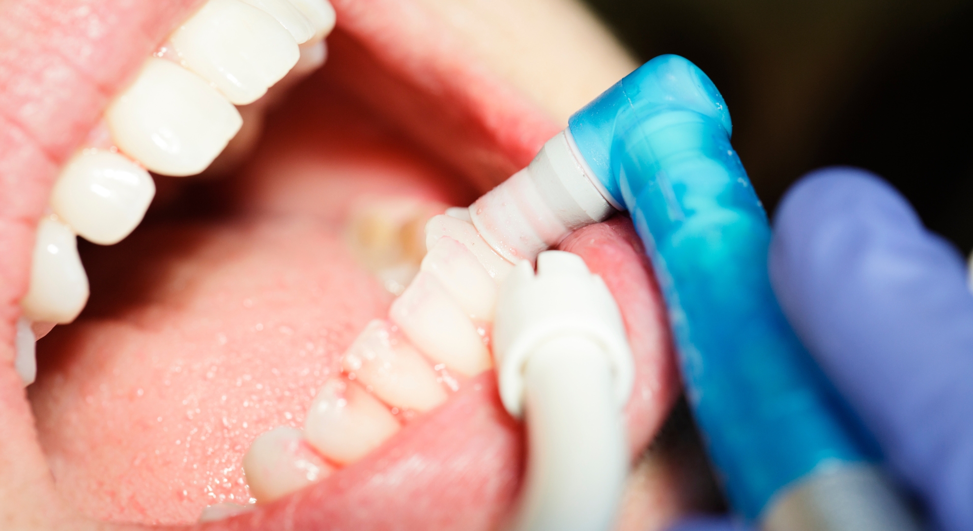 Close-up of a dental cleaning