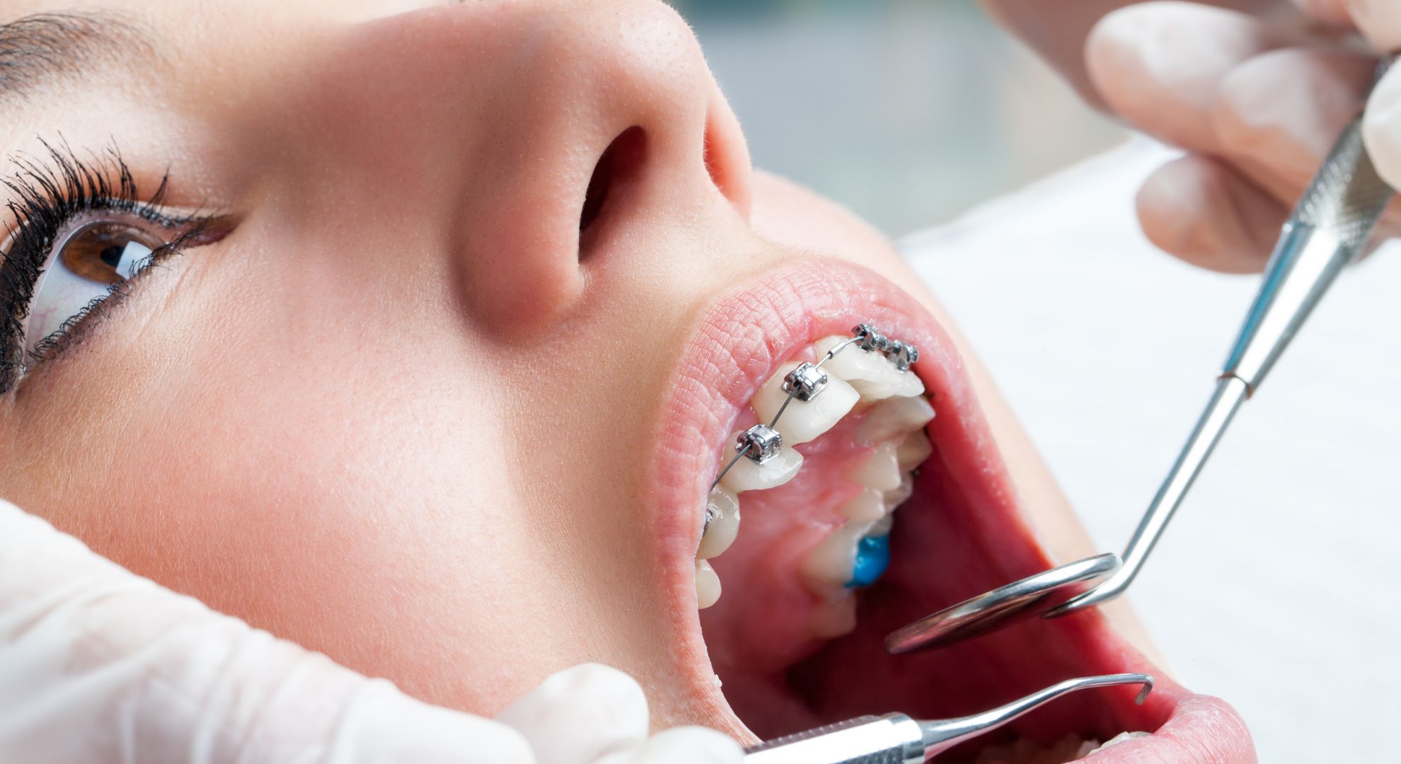 Braces for Adults - Featured Image