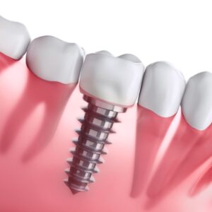 graphic of dental implant