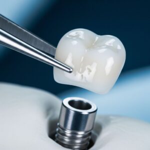  custom-made dental crown ready for attachment