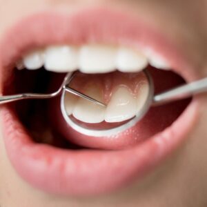  close-up, high-quality image of a patient's open mouth during a dental exam. A dentist or hygienist uses a dental mirror to check the teeth, which are clean and healthy.