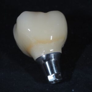 dental tooth implant