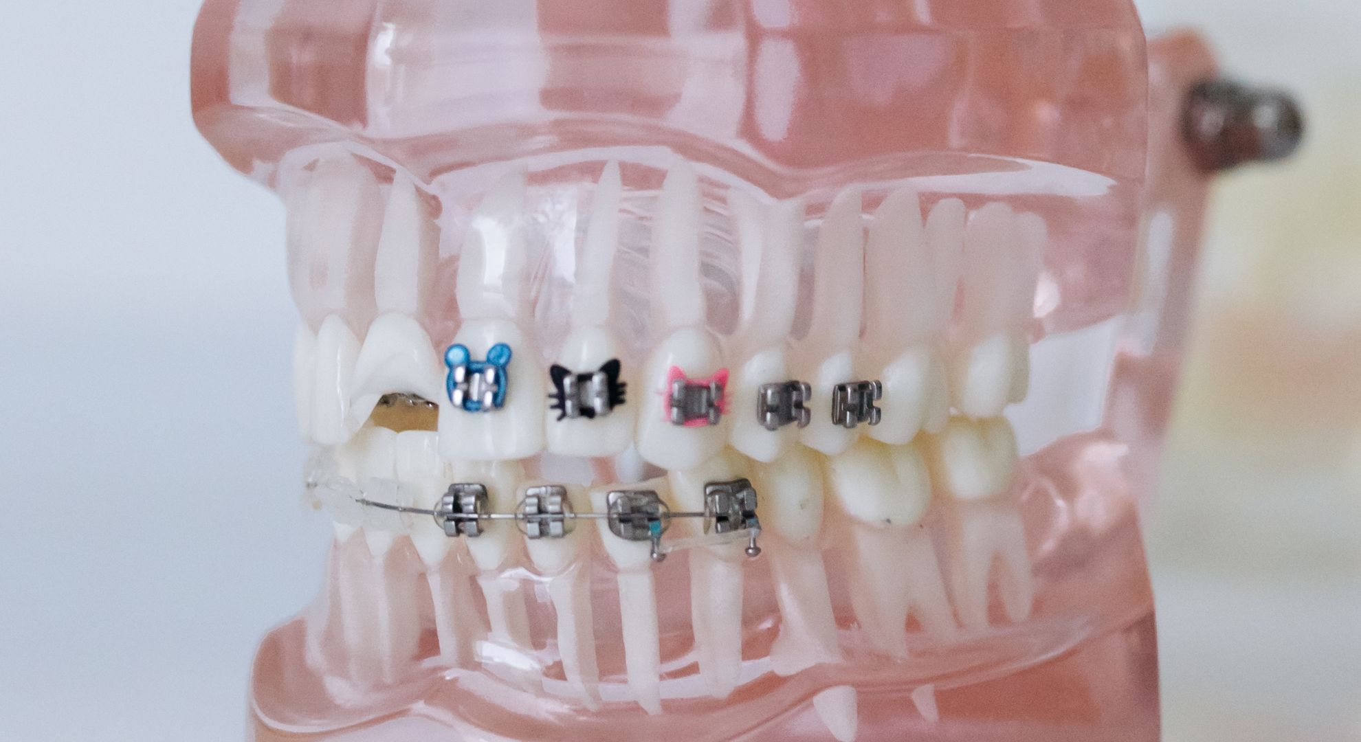 Common Myths About Braces Debunked feature